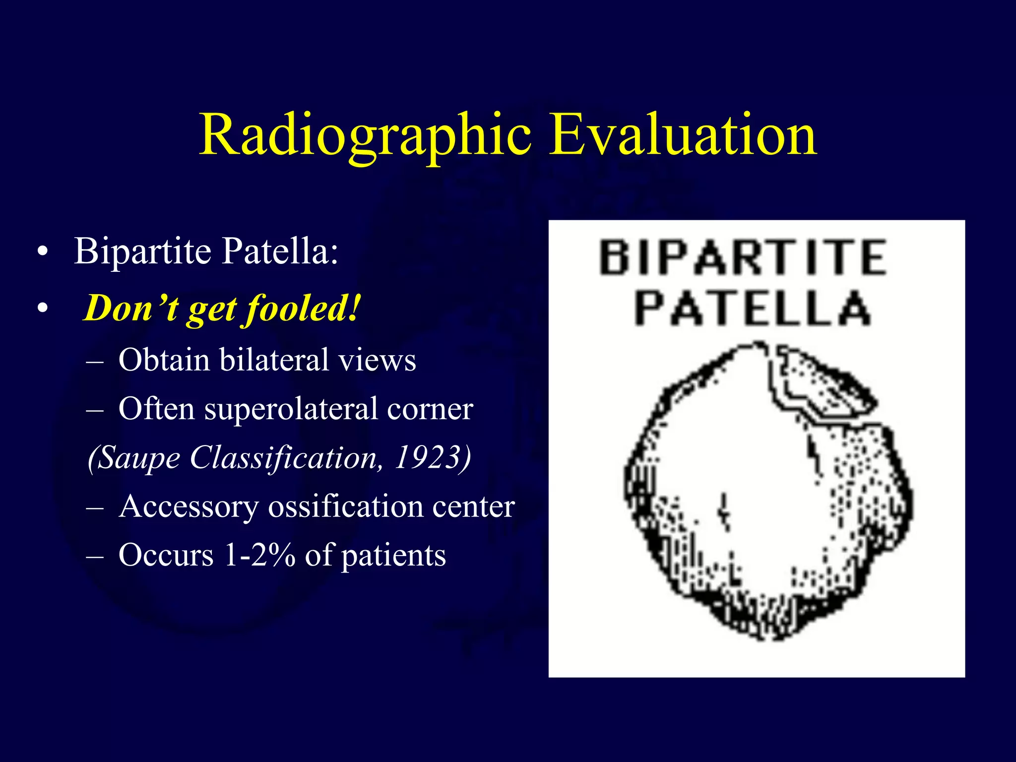 Radiographic Evaluation
• Bipartite Patella:
• Don’t get fooled!
– Obtain bilateral views
– Often superolateral corner
(Saupe Classification, 1923)
– Accessory ossification center
– Occurs 1-2% of patients
 