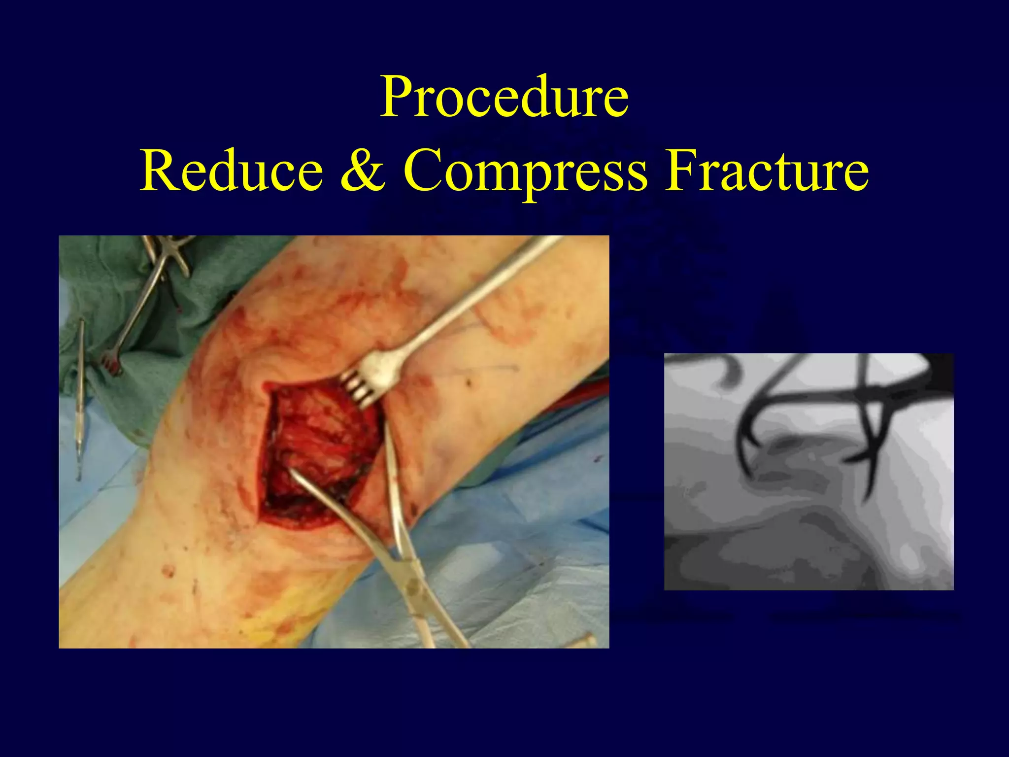 Procedure
Reduce & Compress Fracture
 