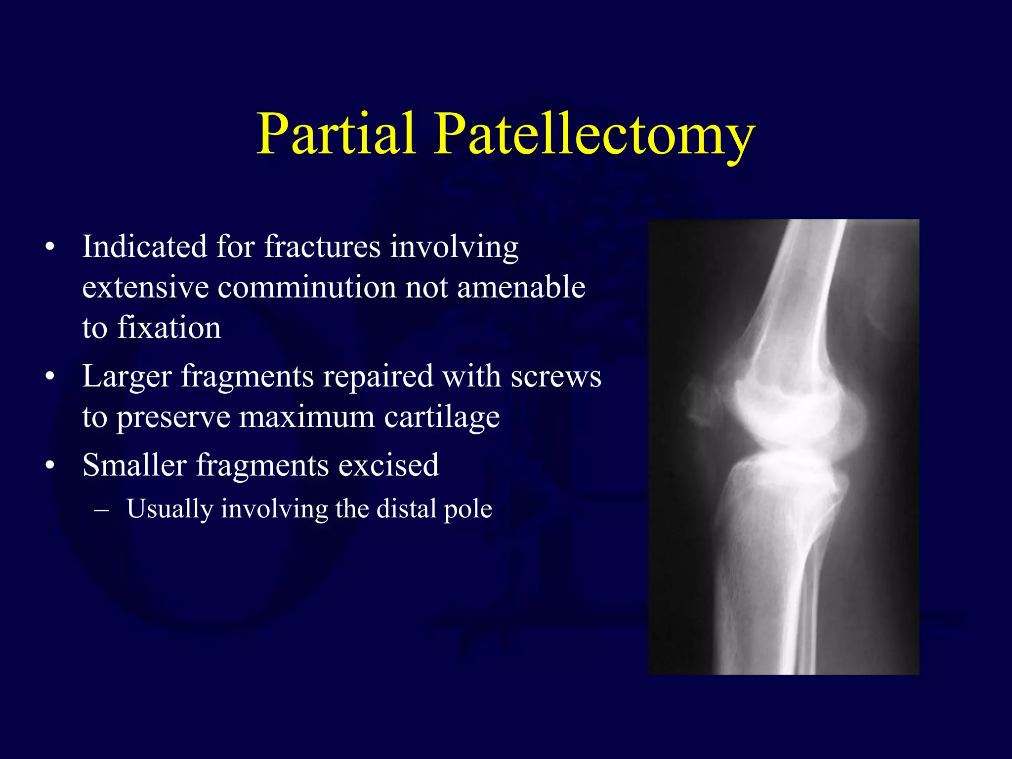 Partial Patellectomy
• Indicated for fractures involving
extensive comminution not amenable
to fixation
• Larger fragments repaired with screws
to preserve maximum cartilage
• Smaller fragments excised
– Usually involving the distal pole
 