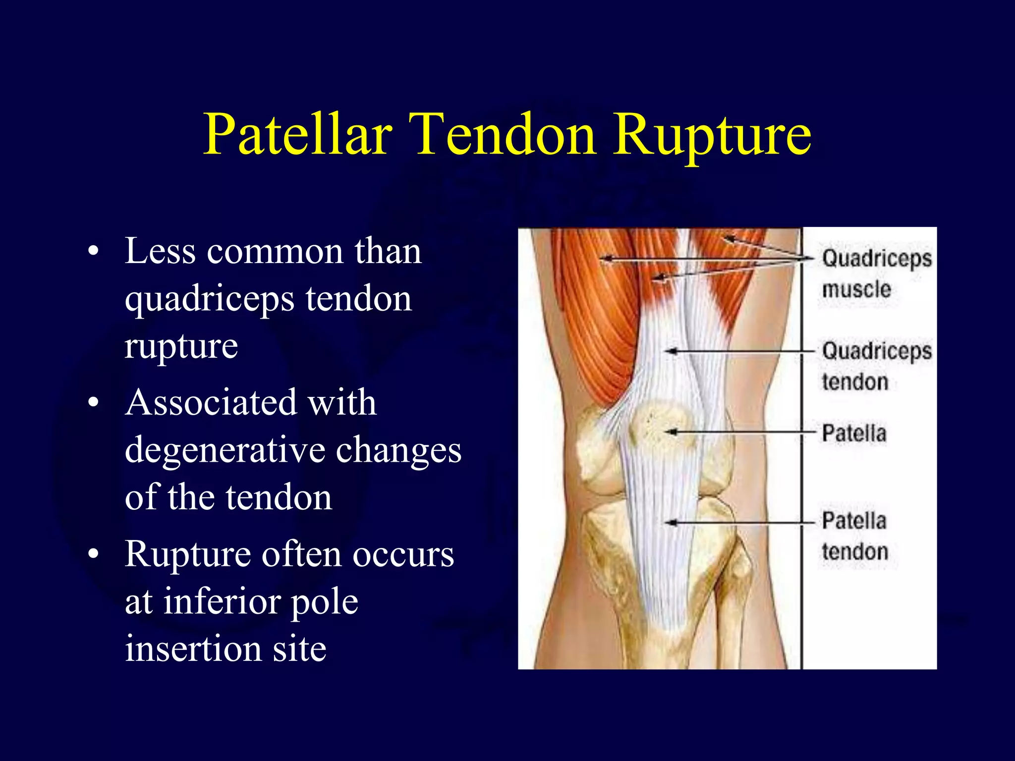 Patellar Tendon Rupture
• Less common than
quadriceps tendon
rupture
• Associated with
degenerative changes
of the tendon
• Rupture often occurs
at inferior pole
insertion site
 