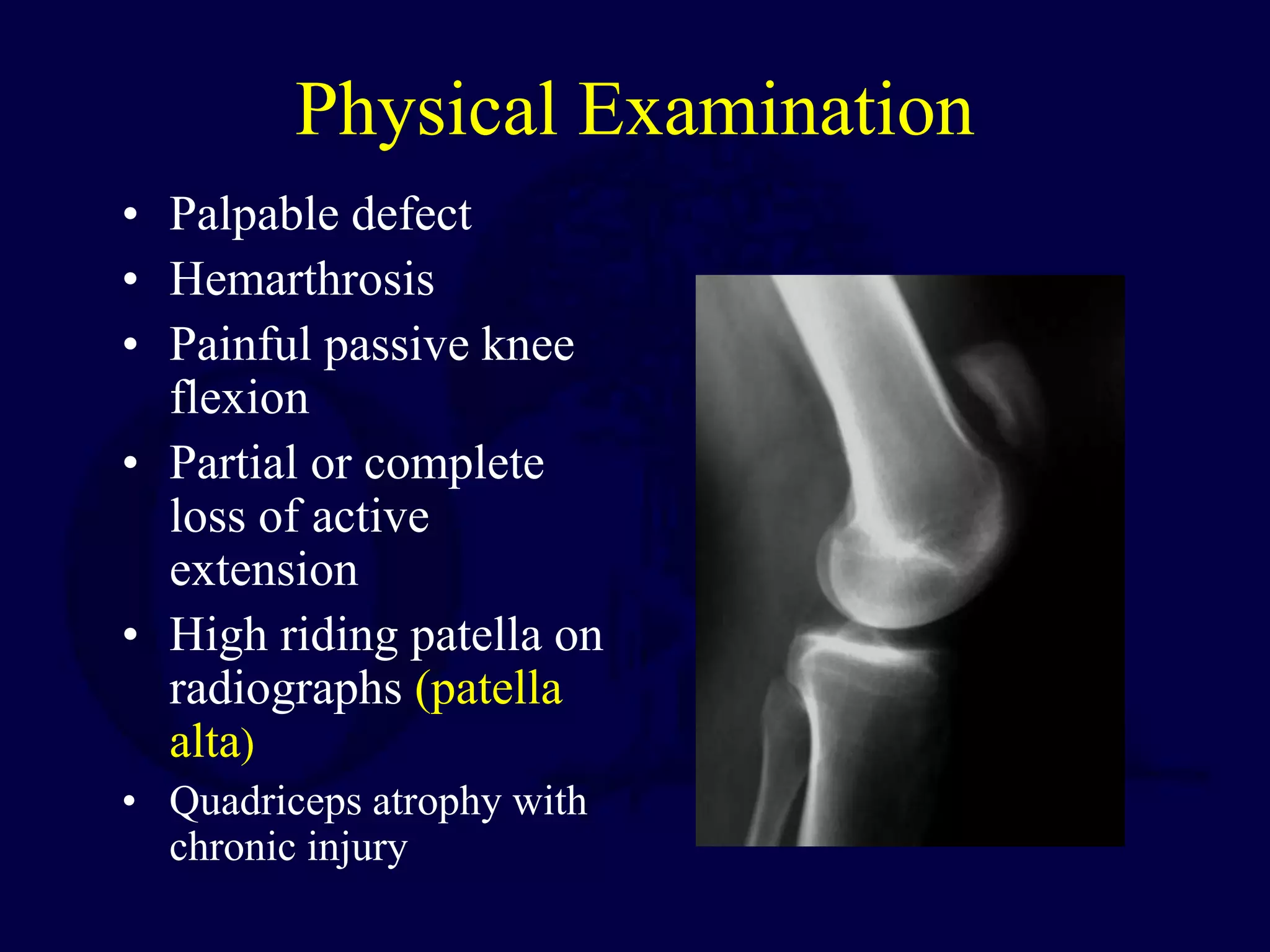 Physical Examination
• Palpable defect
• Hemarthrosis
• Painful passive knee
flexion
• Partial or complete
loss of active
extension
• High riding patella on
radiographs (patella
alta)
• Quadriceps atrophy with
chronic injury
 