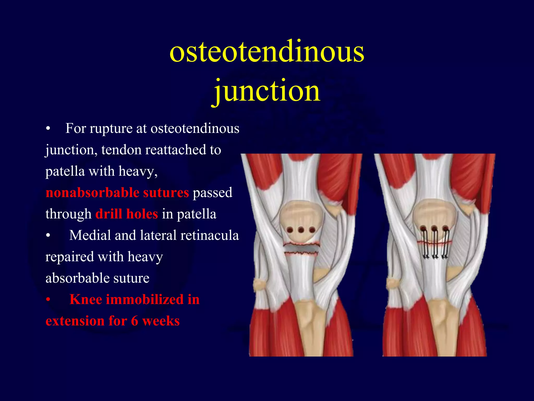 osteotendinous
junction
• For rupture at osteotendinous
junction, tendon reattached to
patella with heavy,
nonabsorbable sutures passed
through drill holes in patella
• Medial and lateral retinacula
repaired with heavy
absorbable suture
• Knee immobilized in
extension for 6 weeks
 