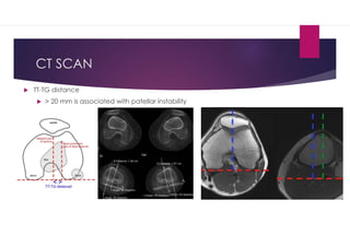 Tt Tg Distance Ct Patella Instability | PDF