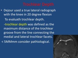 Trochlear Latera Radiograph Patella dislocation by DR.NAVEEN RATHOR | PPTX