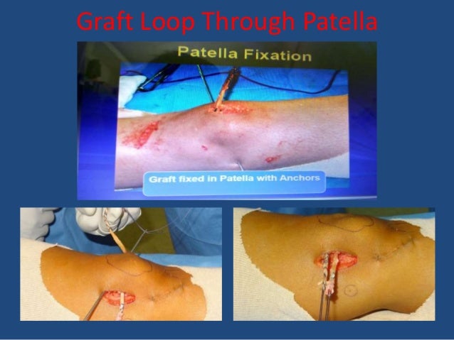 recurrent patellar dislocation surgery