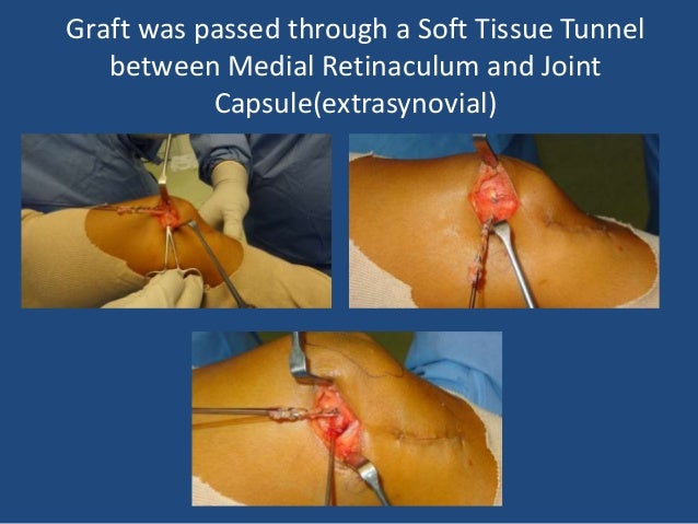 recurrent patellar dislocation surgery