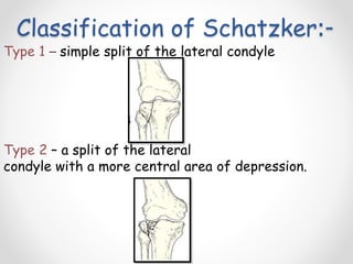 Scthker Classification Patella and tibial plateau fractures | PPTX