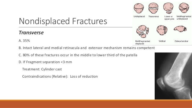 What is a nondisplaced fracture?