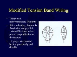 Modified Tension Band Wiring
• Transverse,
noncomminuted fractures
• After reduction, fracture is
fixed with two parallel,
1.6mm Kirschner wires
placed perpendicular to
the fracture
• 18 gauge wire passed
behind proximally and
distally
 