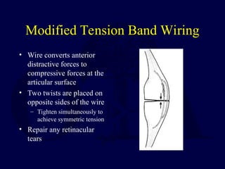Modified Tension Band Wiring
• Wire converts anterior
distractive forces to
compressive forces at the
articular surface
• Two twists are placed on
opposite sides of the wire
– Tighten simultaneously to
achieve symmetric tension
• Repair any retinacular
tears
 