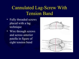 Cannulated Lag-Screw With
Tension Band
• Fully threaded screws
placed with a lag
technique
• Wire through screws
and across anterior
patella in figure of
eight tension band
 