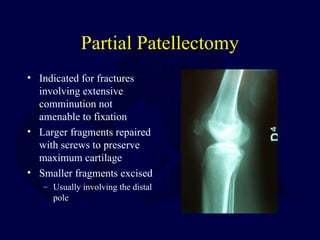 Partial Patellectomy
• Indicated for fractures
involving extensive
comminution not
amenable to fixation
• Larger fragments repaired
with screws to preserve
maximum cartilage
• Smaller fragments excised
– Usually involving the distal
pole
 