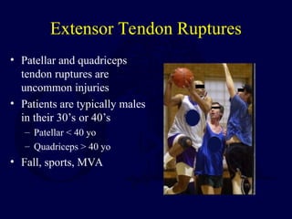 Extensor Tendon Ruptures
• Patellar and quadriceps
tendon ruptures are
uncommon injuries
• Patients are typically males
in their 30’s or 40’s
– Patellar < 40 yo
– Quadriceps > 40 yo
• Fall, sports, MVA
 