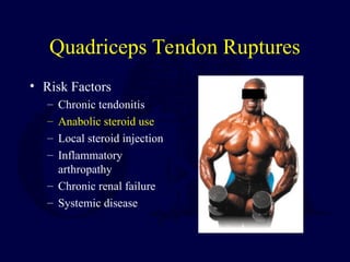 Quadriceps Tendon Ruptures
• Risk Factors
– Chronic tendonitis
– Anabolic steroid use
– Local steroid injection
– Inflammatory
arthropathy
– Chronic renal failure
– Systemic disease
 