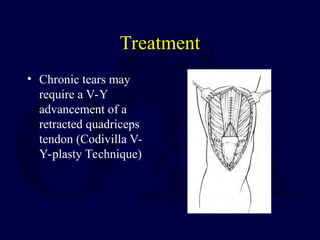Treatment
• Chronic tears may
require a V-Y
advancement of a
retracted quadriceps
tendon (Codivilla V-
Y-plasty Technique)
 