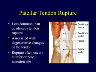 Patellar Tendon Rupture
• Less common than
quadriceps tendon
rupture
• Associated with
degenerative changes
of the tendon
• Rupture often occurs
at inferior pole
insertion site
 