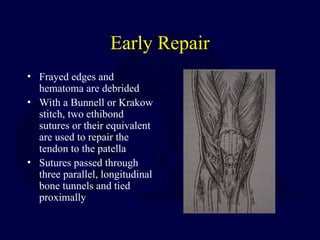 Early Repair
• Frayed edges and
hematoma are debrided
• With a Bunnell or Krakow
stitch, two ethibond
sutures or their equivalent
are used to repair the
tendon to the patella
• Sutures passed through
three parallel, longitudinal
bone tunnels and tied
proximally
 
