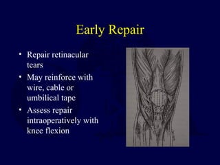Early Repair
• Repair retinacular
tears
• May reinforce with
wire, cable or
umbilical tape
• Assess repair
intraoperatively with
knee flexion
 