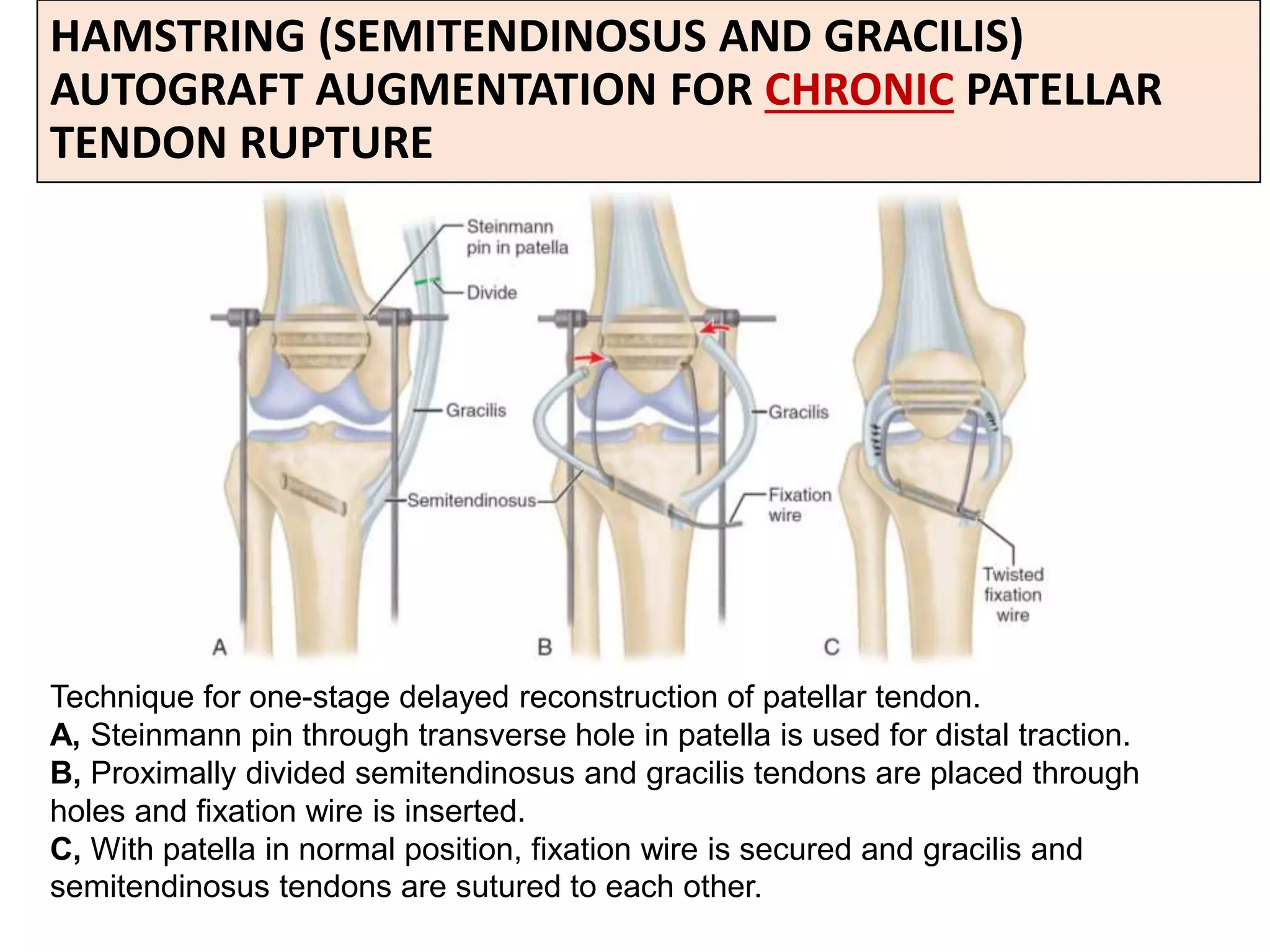 Patellar and quadriceps tendon rupture | PPTX