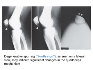 Degenerative spurring (“tooth sign”), as seen on a lateral
view, may indicate significant changes in the quadriceps
mechanism
 