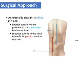Surgical Approach
• An extensile straight midline
incision
• inferior patella to 5 cm
proximal to the quadriceps
tendon rupture
• superior patella to the tibial
tubercle for patellar tendon
ruptures.
5cm
 