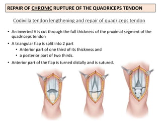 Codivilla tendon lengthening and repair of quadriceps tendon
• An inverted V is cut through the full thickness of the proximal segment of the
quadriceps tendon
• A triangular flap is split into 2 part
• Anterior part of one third of its thickness and
• a posterior part of two thirds.
• Anterior part of the flap is turned distally and is sutured.
REPAIR OF CHRONIC RUPTURE OF THE QUADRICEPS TENDON
 