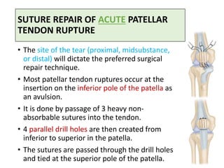 SUTURE REPAIR OF ACUTE PATELLAR
TENDON RUPTURE
• The site of the tear (proximal, midsubstance,
or distal) will dictate the preferred surgical
repair technique.
• Most patellar tendon ruptures occur at the
insertion on the inferior pole of the patella as
an avulsion.
• It is done by passage of 3 heavy non-
absorbable sutures into the tendon.
• 4 parallel drill holes are then created from
inferior to superior in the patella.
• The sutures are passed through the drill holes
and tied at the superior pole of the patella.
 
