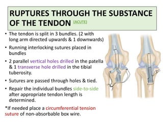 RUPTURES THROUGH THE SUBSTANCE
OF THE TENDON
• The tendon is split in 3 bundles. (2 with
long arm directed upwards & 1 downwards)
• Running interlocking sutures placed in
bundles
• 2 parallel vertical holes drilled in the patella
& 1 transverse hole drilled in the tibial
tuberosity.
• Sutures are passed through holes & tied.
• Repair the individual bundles side-to-side
after appropriate tendon length is
determined.
*If needed place a circumferential tension
suture of non-absorbable box wire.
(ACUTE)
 