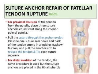 SUTURE ANCHOR REPAIR OF PATELLAR
TENDON RUPTURE
• For proximal avulsion of the tendon
from the patella, place three suture
anchors equidistant along the inferior
pole of patella.
• Pull the suture through the anchor eyelet
Pass the one suture arm down and back
of the tendon stump in a locking Krackow
fashion, and pull the another arm to
reduce the tendon & Tie each suture
securely.
• For distal avulsion of the tendon, the
same procedure is used but the suture
anchors are placed in the tibial tubercle
(ACUTE)
 