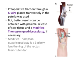 • Preoperative traction through a
K-wire placed transversely in the
patella was used
• But, better results can be
obtained with proximal release
of scar tissue and a modified
Thompson quadricepsplasty, if
necessary.
• Modified Thompson
quadricepsplasty is a Z-plasty
lengthening of the rectus
femoris tendon
 