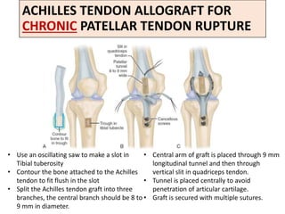 ACHILLES TENDON ALLOGRAFT FOR
CHRONIC PATELLAR TENDON RUPTURE
• Use an oscillating saw to make a slot in
Tibial tuberosity
• Contour the bone attached to the Achilles
tendon to fit flush in the slot
• Split the Achilles tendon graft into three
branches, the central branch should be 8 to
9 mm in diameter.
• Central arm of graft is placed through 9 mm
longitudinal tunnel and then through
vertical slit in quadriceps tendon.
• Tunnel is placed centrally to avoid
penetration of articular cartilage.
• Graft is secured with multiple sutures.
 