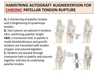 HAMSTRING AUTOGRAFT AUGMENTATION FOR
CHRONIC PATELLAR TENDON RUPTURE
A, Z-shortening of patellar tendon
and Z-lengthening of quadriceps
tendon.
B, Tack sutures are placed in tendons
after confirming patellar height
C&D, a transverse hole in patella is
made Semitendinosus and gracilis
tendons are harvested with tendon
stripper and sutured together.
E, Tendons are passed through
transverse hole in patella and sutured
together and also to underlying
patellar tendon.
 