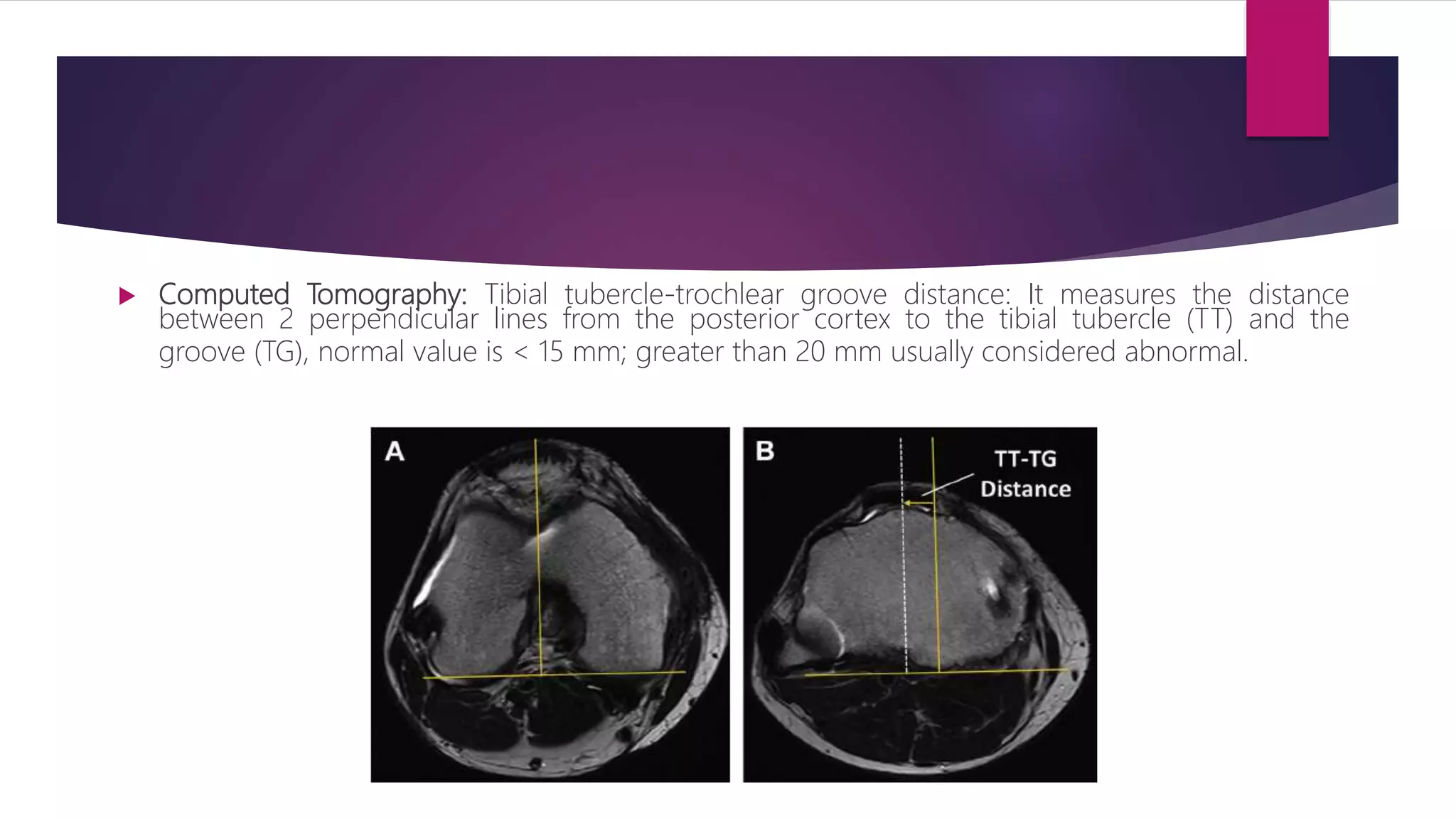  Computed Tomography: Tibial tubercle-trochlear groove distance: It measures the distance
between 2 perpendicular lines from the posterior cortex to the tibial tubercle (TT) and the
groove (TG), normal value is < 15 mm; greater than 20 mm usually considered abnormal.
 