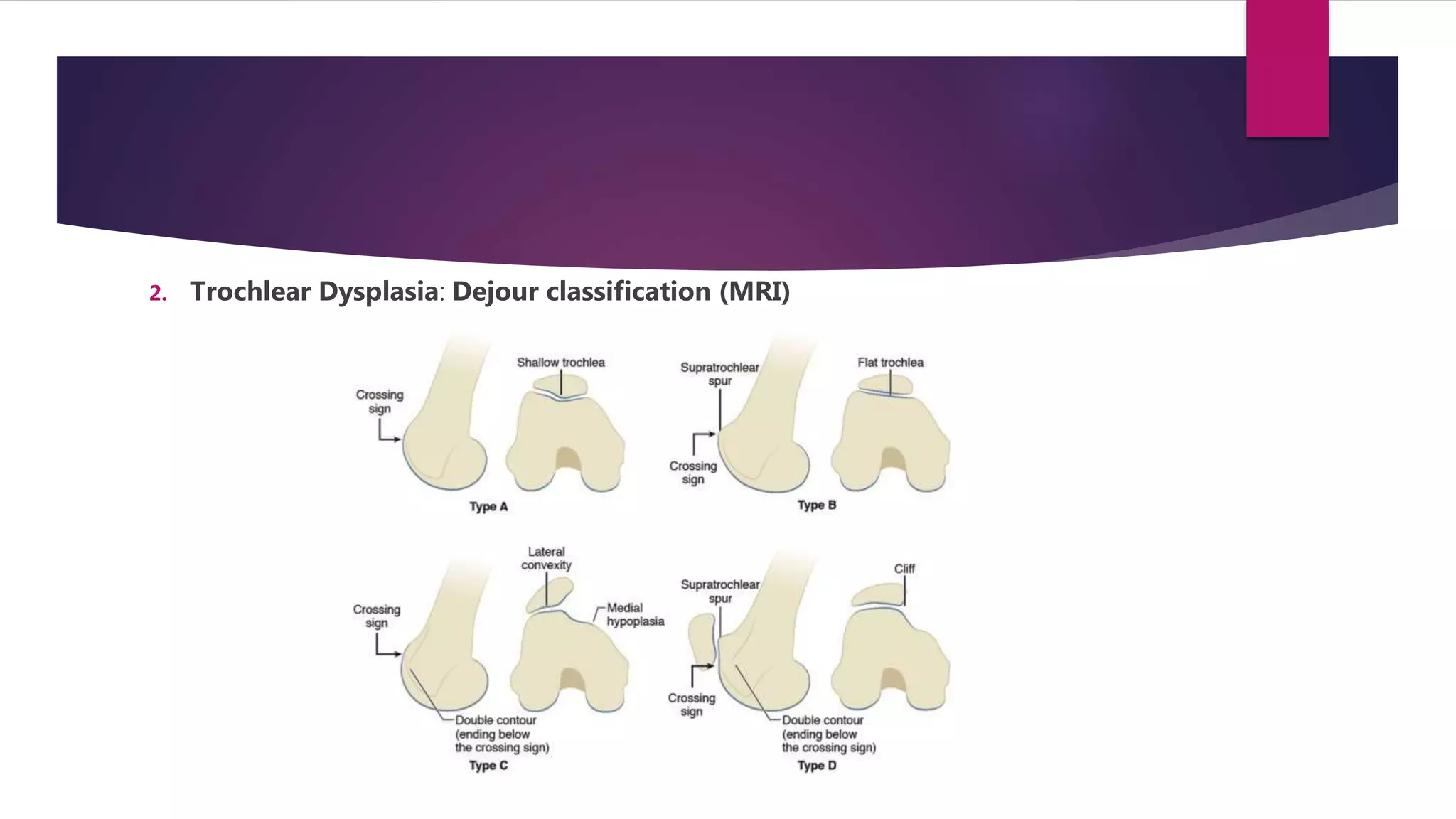 2. Trochlear Dysplasia: Dejour classification (MRI)
 
