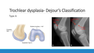 Trochlear Dejer Patellar Instability | PPTX