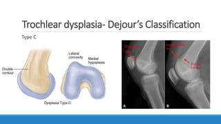 Patellar Instability | PPTX