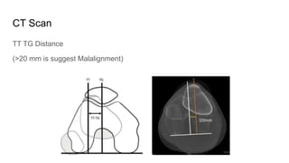Tt Tg Distance Ct Patellar Instability: Diagnosis Management | PDF