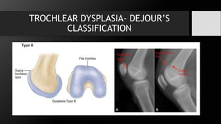 Trochlear Dejer Patellar instability.pptx , introduction, anatomy | PPTX