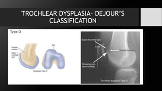 Trochlear Dejer Patellar instability.pptx , introduction, anatomy | PPTX