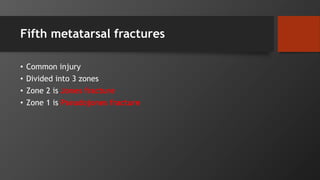 Fifth metatarsal fractures
• Common injury
• Divided into 3 zones
• Zone 2 is Jones fracture
• Zone 1 is Pseudojones fracture
 