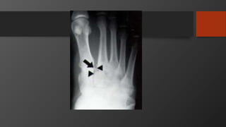 Patella, tibia, foot and ankle injuries