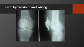 ORIF by tension band wiring
 
