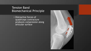 Tension Band
Biomechanical Principle
• Distractive forces of
quadriceps contracture
produces compression along
articular surface
 