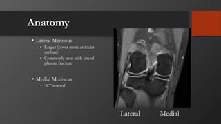 Anatomy
• Lateral Meniscus
• Larger (cover more articular
surface)
• Commonly torn with lateral
plateau fracture
• Medial Meniscus
• “C” shaped
MedialLateral
 