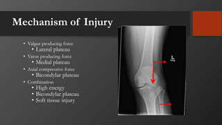 Mechanism of Injury
• Valgus producing force
• Lateral plateau
• Varus producing force
• Medial plateau
• Axial compressive force
• Bicondylar plateau
• Combination
• High energy
• Bicondylar plateau
• Soft tissue injury
 