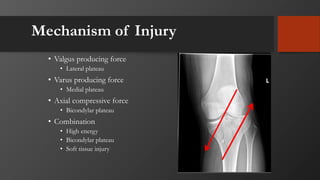 Mechanism of Injury
• Valgus producing force
• Lateral plateau
• Varus producing force
• Medial plateau
• Axial compressive force
• Bicondylar plateau
• Combination
• High energy
• Bicondylar plateau
• Soft tissue injury
 