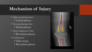 Mechanism of Injury
• Valgus producing force
• Lateral plateau
• Varus producing force
• Medial plateau
• Axial compressive force
• Bicondylar plateau
• Combination
• High energy
• Bicondylar plateau
 