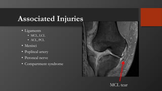 Associated Injuries
• Ligaments
• MCL, LCL
• ACL, PCL
• Menisci
• Popliteal artery
• Peroneal nerve
• Compartment syndrome
MCL tear
 