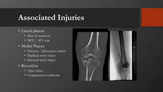 Associated Injuries
• Lateral plateau
• Tear of meniscus
• MCL / ACL tear
• Medial Plateau
• Fracture / dislocation variant
• Popliteal artery injury
• Peroneal nerve injury
• Bicondylar
• Open injury
• Compartment syndrome
 