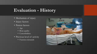 Evaluation - History
• Mechanism of injury
• Injury factors
• Patient factors
• Age
• Bone quality
• Comorbidities
• Previous level of activity
• Function demands
 